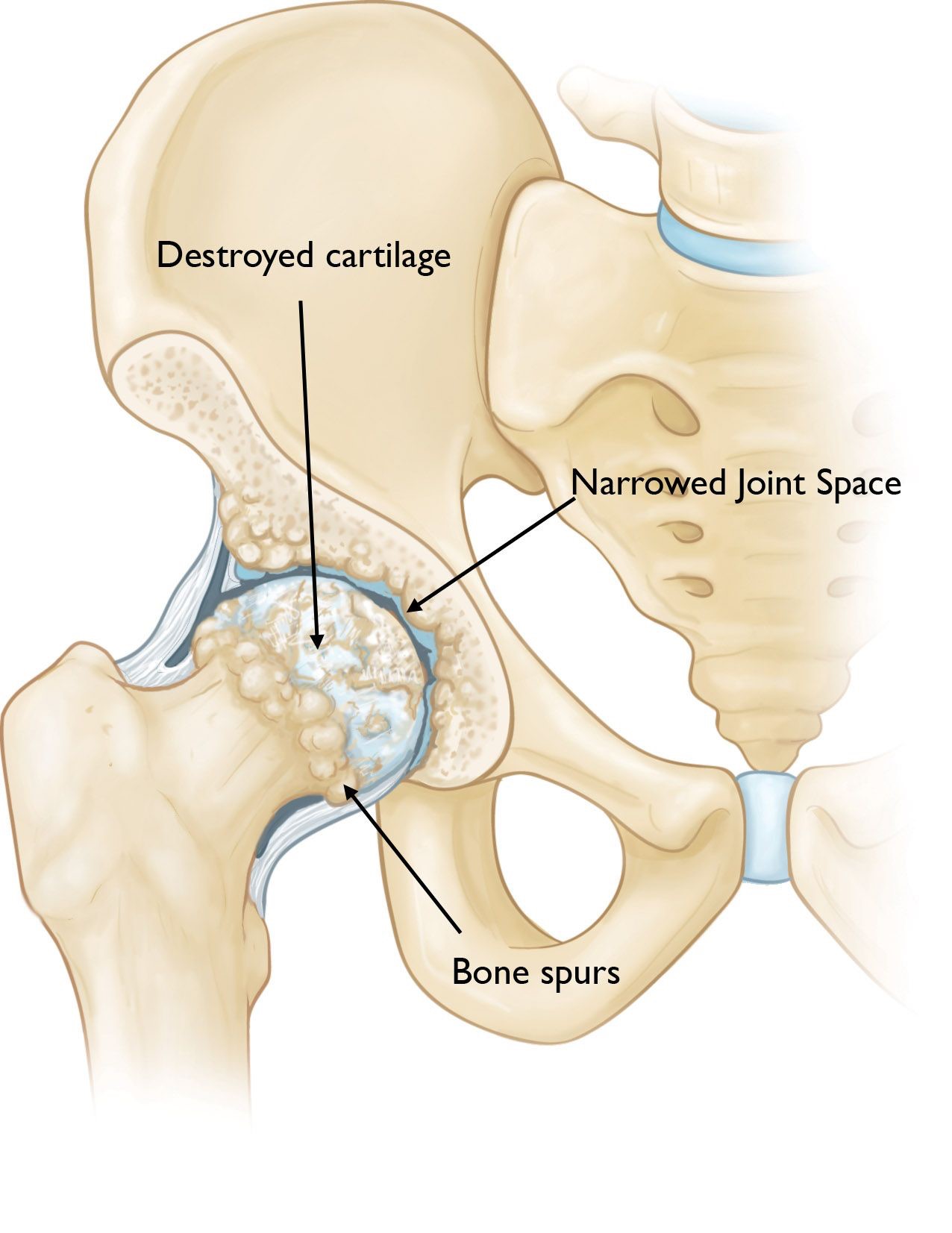 Osteoarthritis of the hip image 1