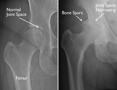 Osteoarthritis of the hip image 2