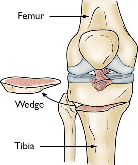 Osteotomy Of The Knee 2