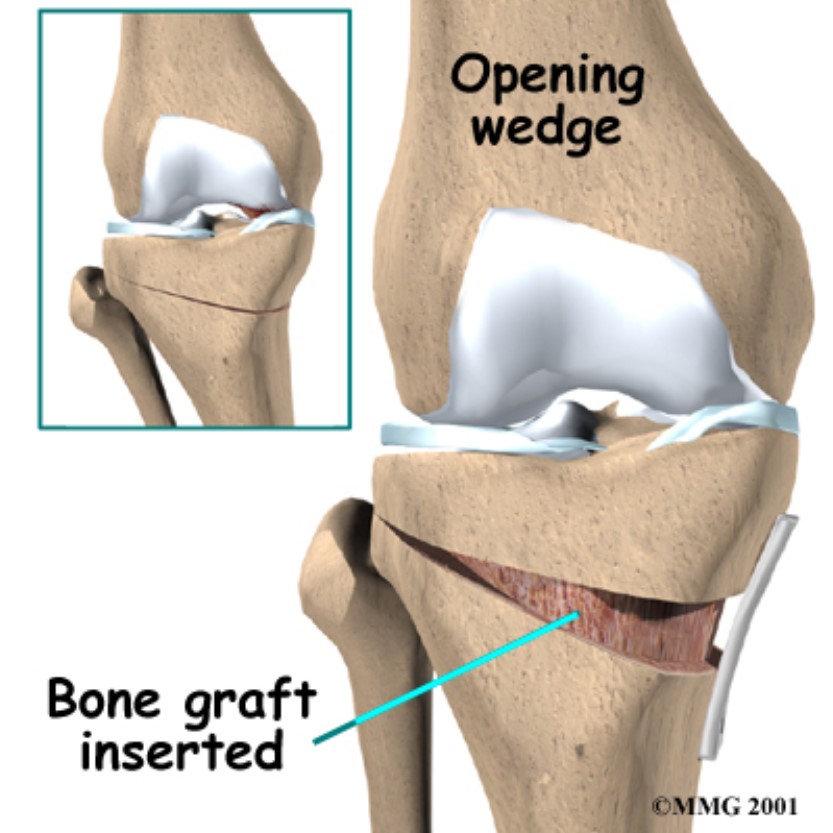 Osteotomy Of The Knee 3