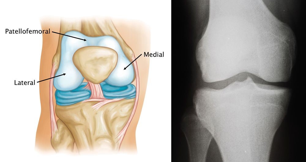 Patellofemoral Joint Replacement 1