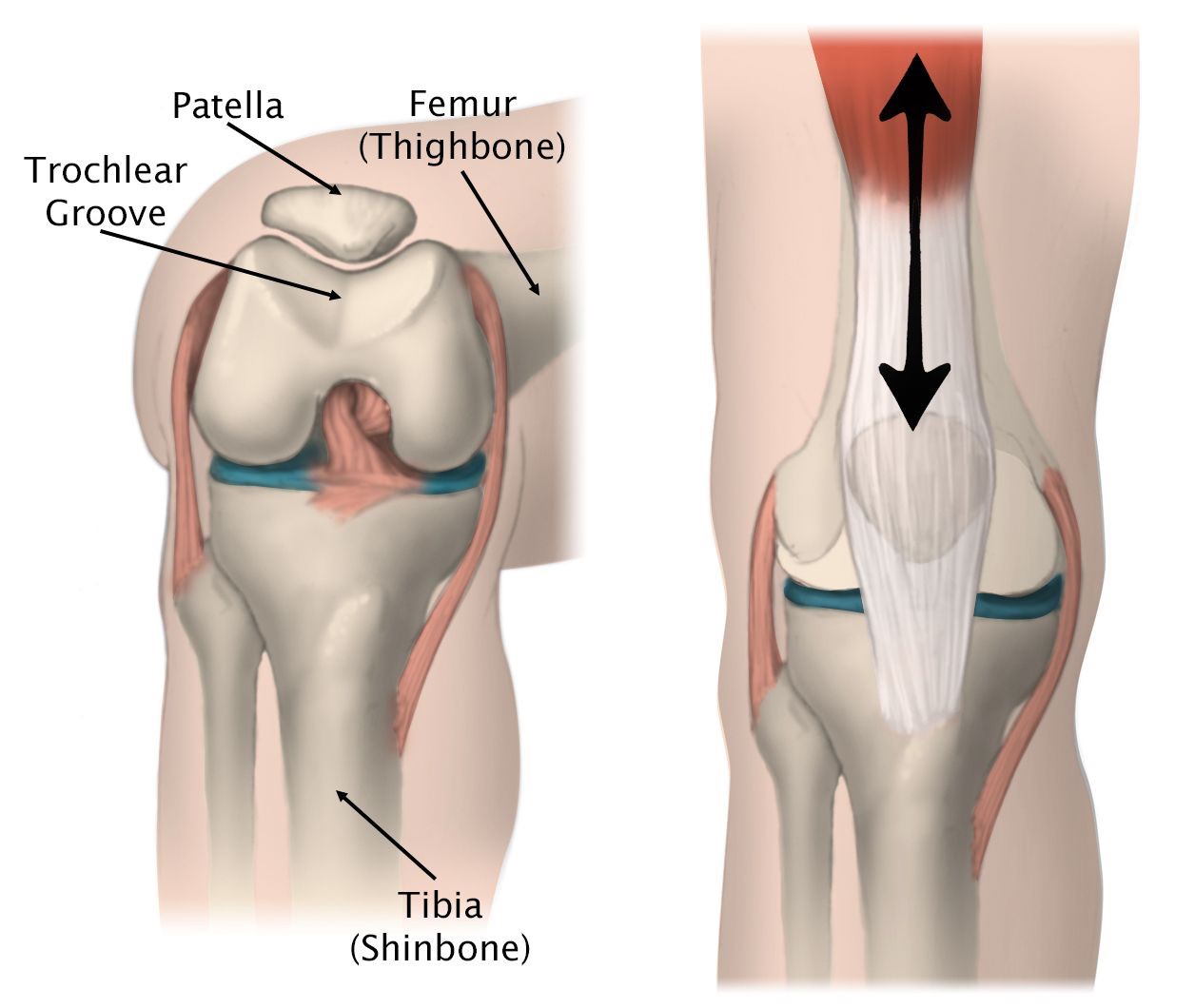 Patellofemoral Joint Replacement 2