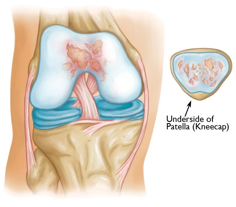 Patellofemoral Joint Replacement 3