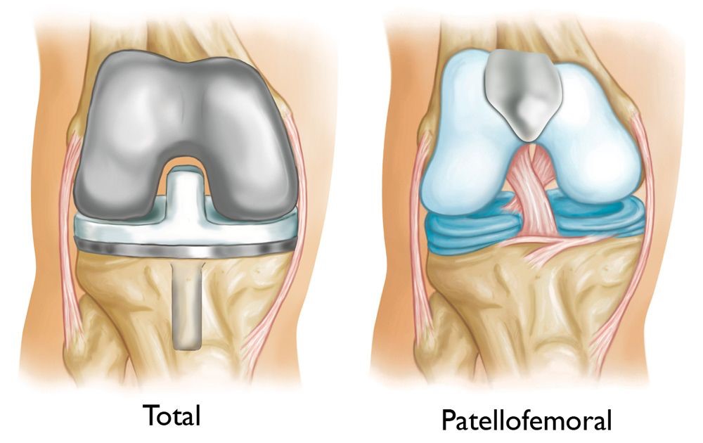 Patellofemoral Joint Replacement 4