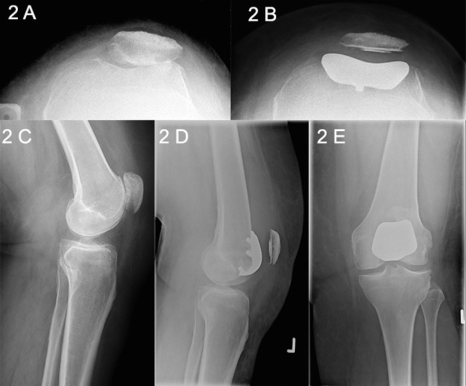 Patellofemoral Joint Replacement 6