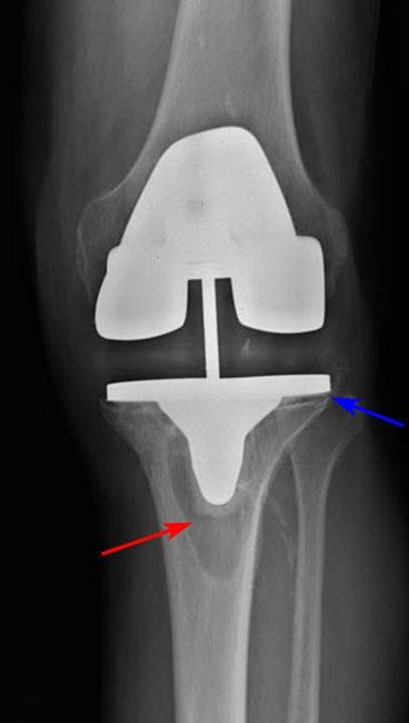 Revision Total Knee Replacement RevTKR 2