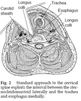 Cervical Radiculopathy 3