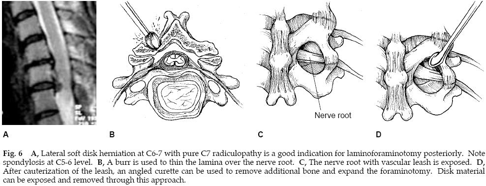 Cervical Radiculopathy 4